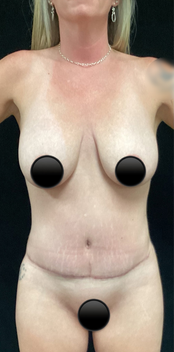 After Image: Breast Augmentation - front