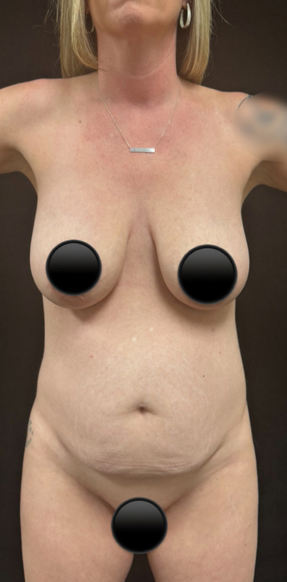 Before Image: Breast Augmentation - front
