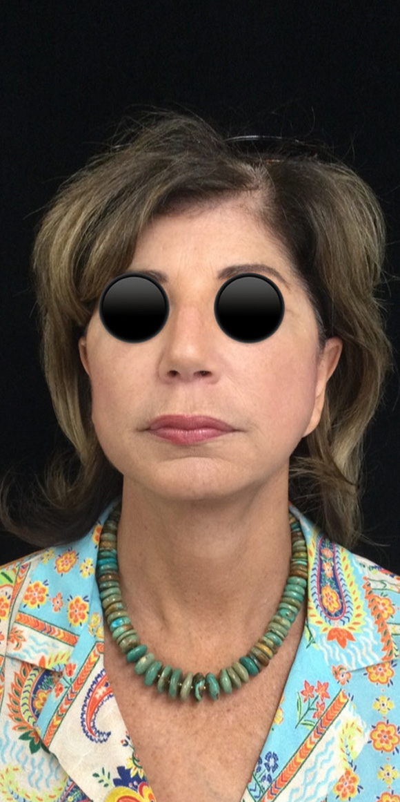 After Image: Facelift - front