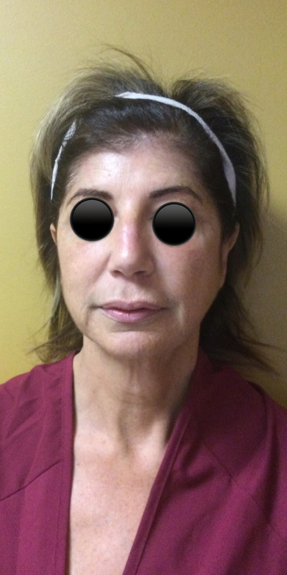 Before Image: Facelift - front