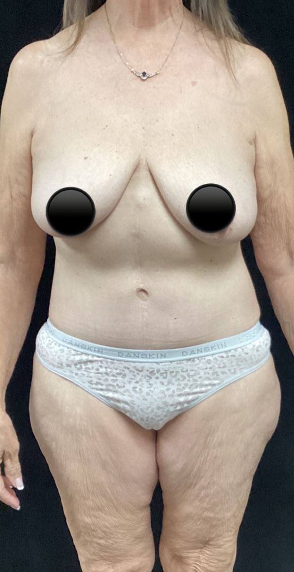 After Image: Abdominoplasty - front