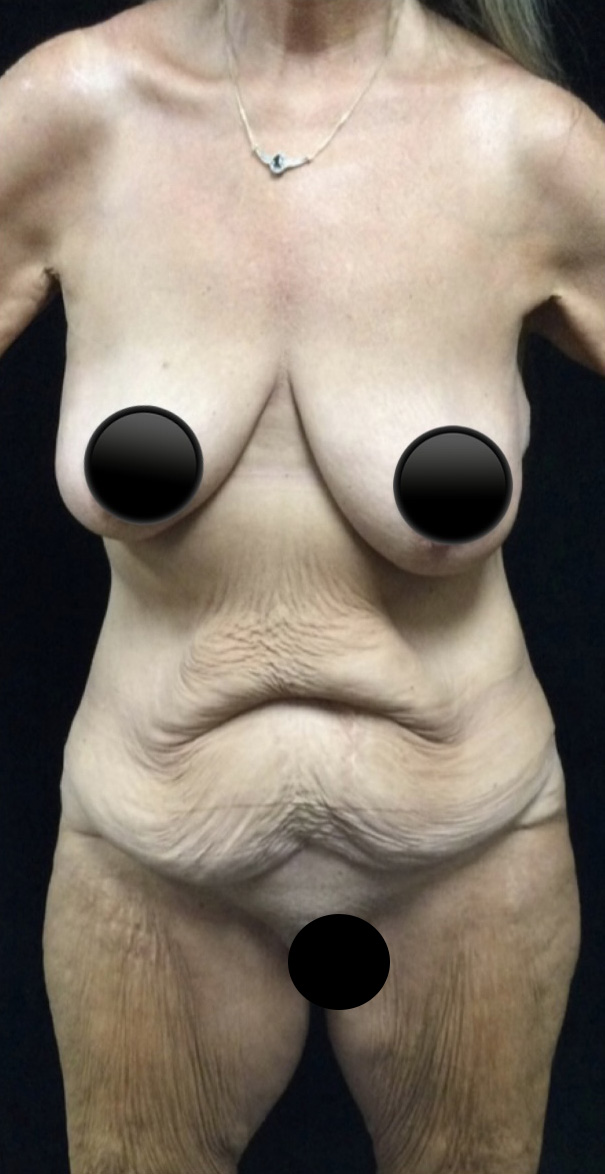 Before Image: Abdominoplasty - front
