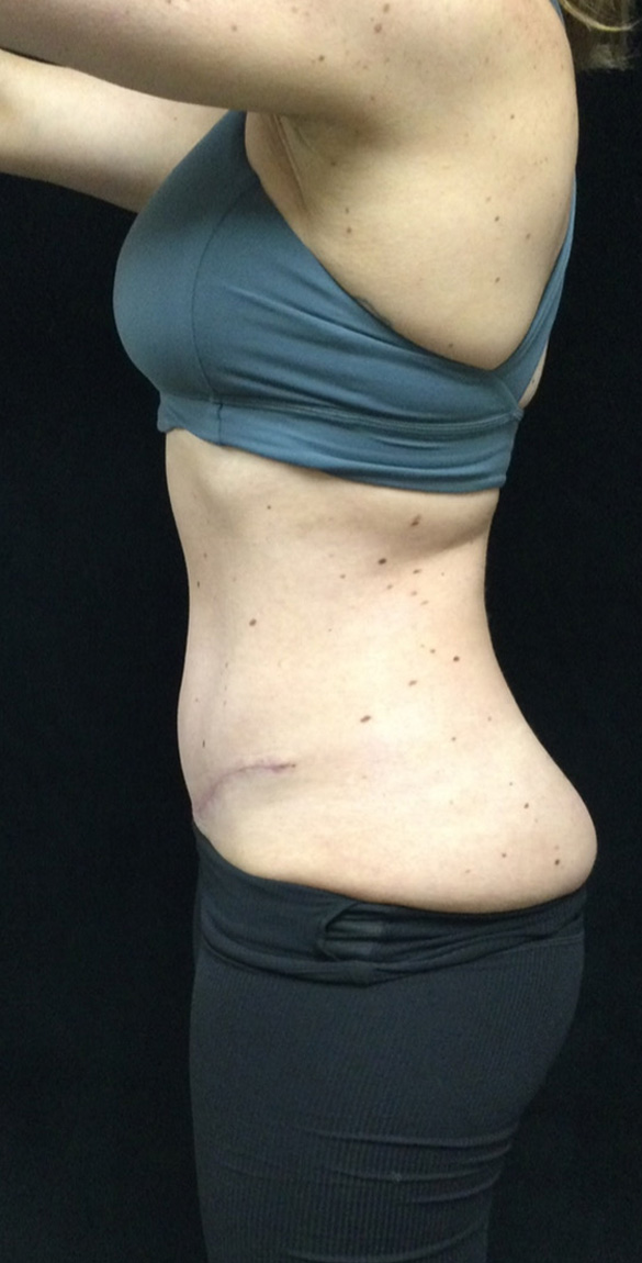 After Image: Abdominoplasty - left-side