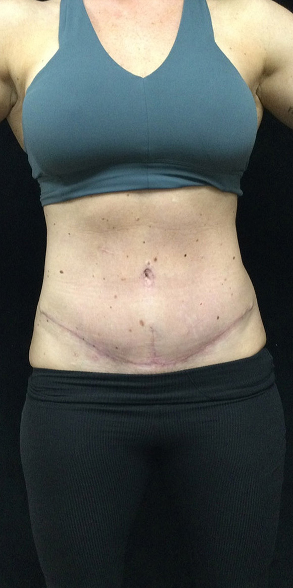 After Image: Abdominoplasty - front