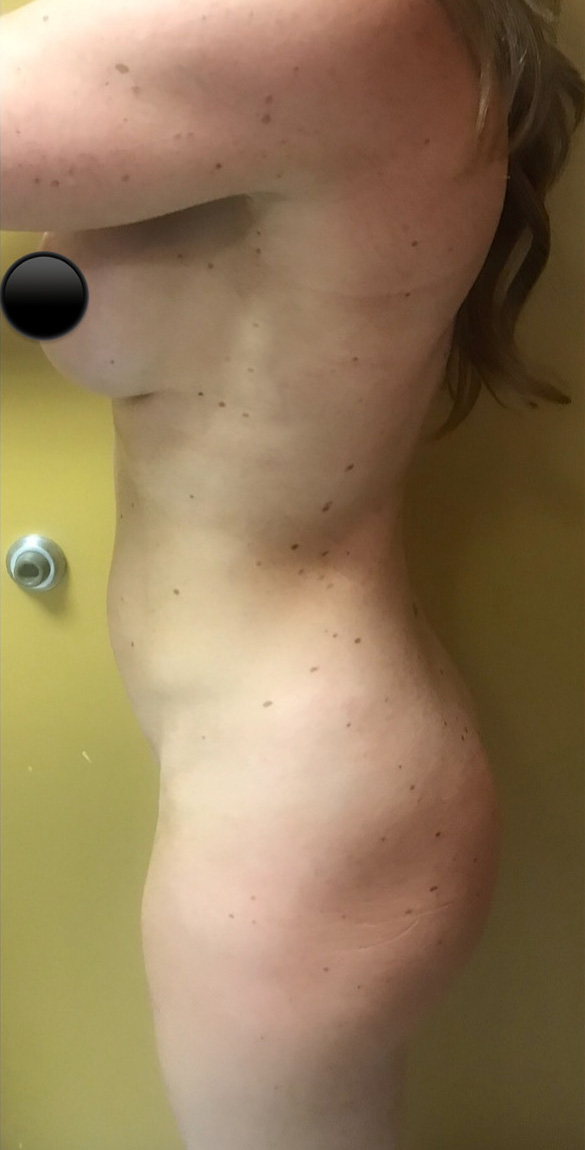 Before Image: Abdominoplasty - left-side