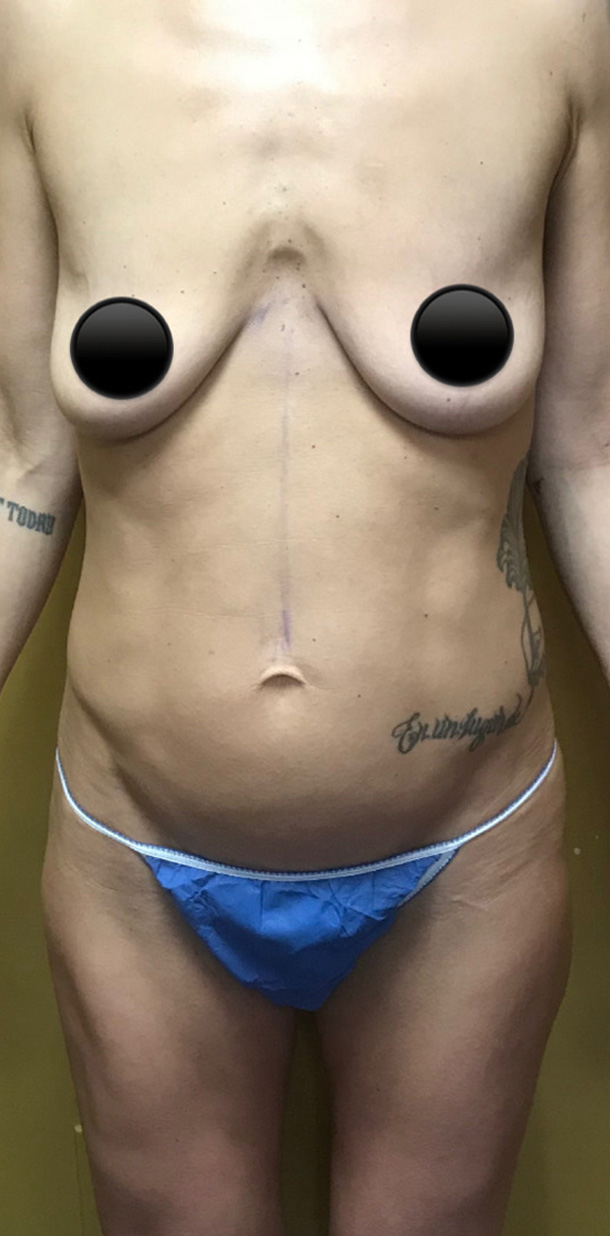 Before Image: Abdominoplasty - left-side