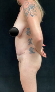 After Image: Abdominoplasty