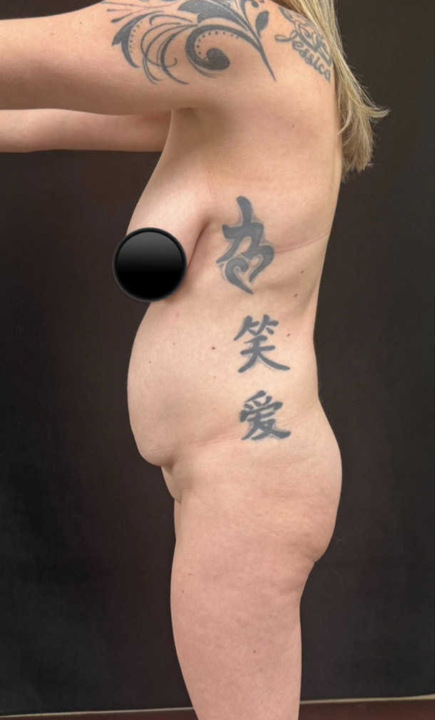 Before Image: Abdominoplasty - left-side