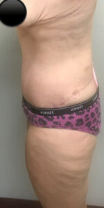 After Image: Abdominoplasty