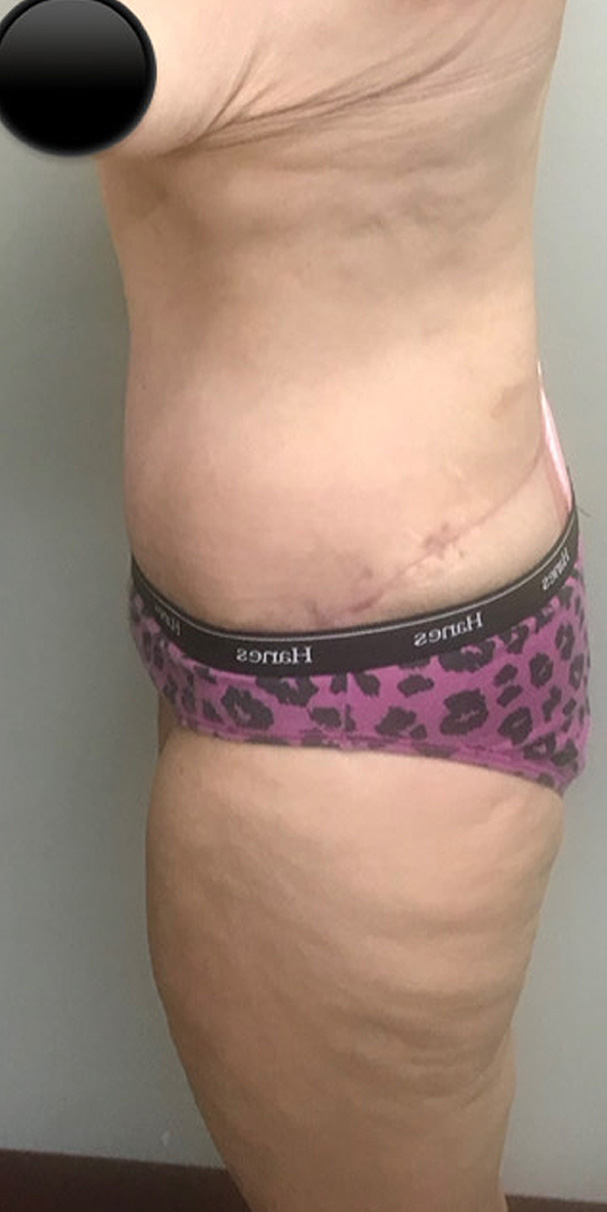 After Image: Abdominoplasty - left-side