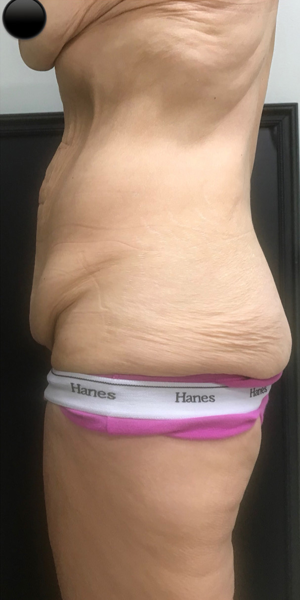 Before Image: Abdominoplasty - left-side